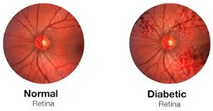 Diabetic Retinopathy